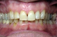 Orthodontic Treatment Case Study